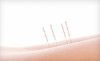 Eagle Rock Community Acupuncture Coupons Los Angeles, California Deals