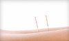 Premier Acupuncture Clinic Coupons Colorado Springs, Colorado Deals