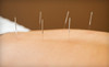 North Nassau Acupuncture LLC Coupons Great Neck, New York Deals