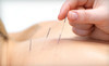 Berkeley Community Acupuncture and Massage Coupons Denver, Colorado Deals