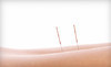 True Nature Acupuncture & Oriental Medicine Coupons Broomfield, Colorado Deals
